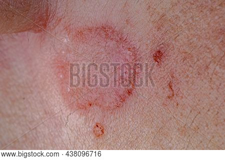 Dermatitis Skin Damage Caused By Beetle Of The Carabidae Family