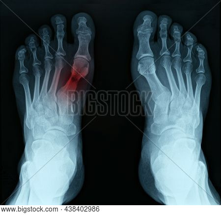 X Ray Of Feet With Tarsal Fracture Closeup. Diagnosis And Treatment Of Lower Limb Injuries Concept