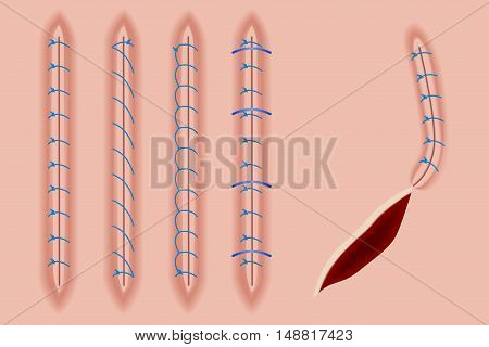 A set of surgical stitches on the skin/Sutures