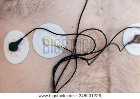 Holter Monitor Device On Human Male Body. Daily Cardiogram Examination. Excess Fat Person. High Risk