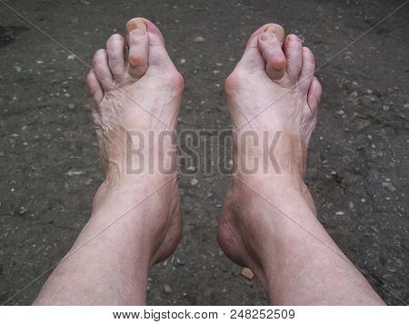 Bare Foots Which Have Hallux Valgus Problem.