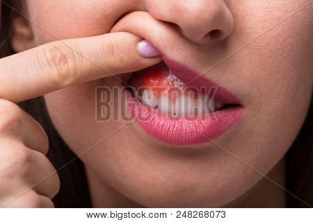 Woman Showing Swelling Of Her Gum