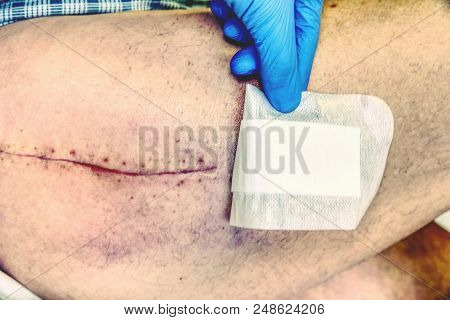 Replacing Of The Devastated Hip Joint For The Hip Endoprosthesis. Selective Focus Of Human Leg With 