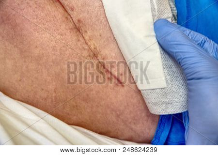 Replacing Of The Devastated Hip Joint For The Hip Endoprosthesis. Selective Focus Of Human Leg With 