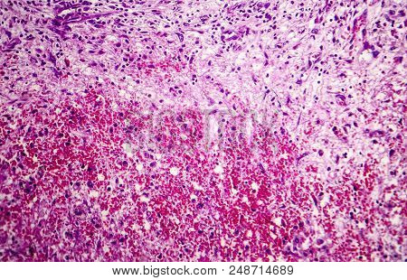 Splenic Infarction, Light Micrograph, Photo Under Microscope