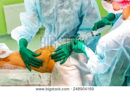 Cosmetic Liposuction Surgery In Actual Operating Room Setting Showing Surgeon Hands And Cannula