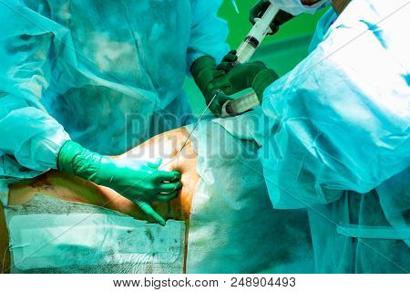 Cosmetic Liposuction Surgery In Actual Operating Room Setting Showing Surgeon Hands And Cannula