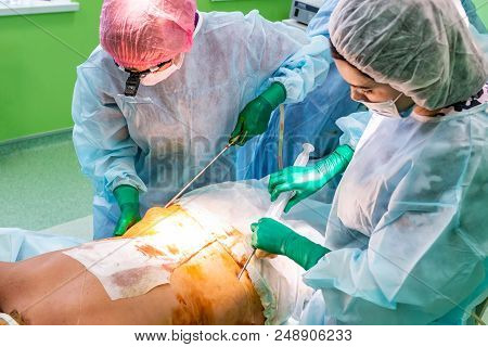 Cosmetic Liposuction Surgery In Actual Operating Room