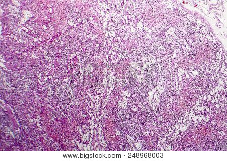 Hemorrhagic Lymphadenitits, Lymph Node Inflammation And Hemorrhage, Light Micrograph, Photo Under Mi