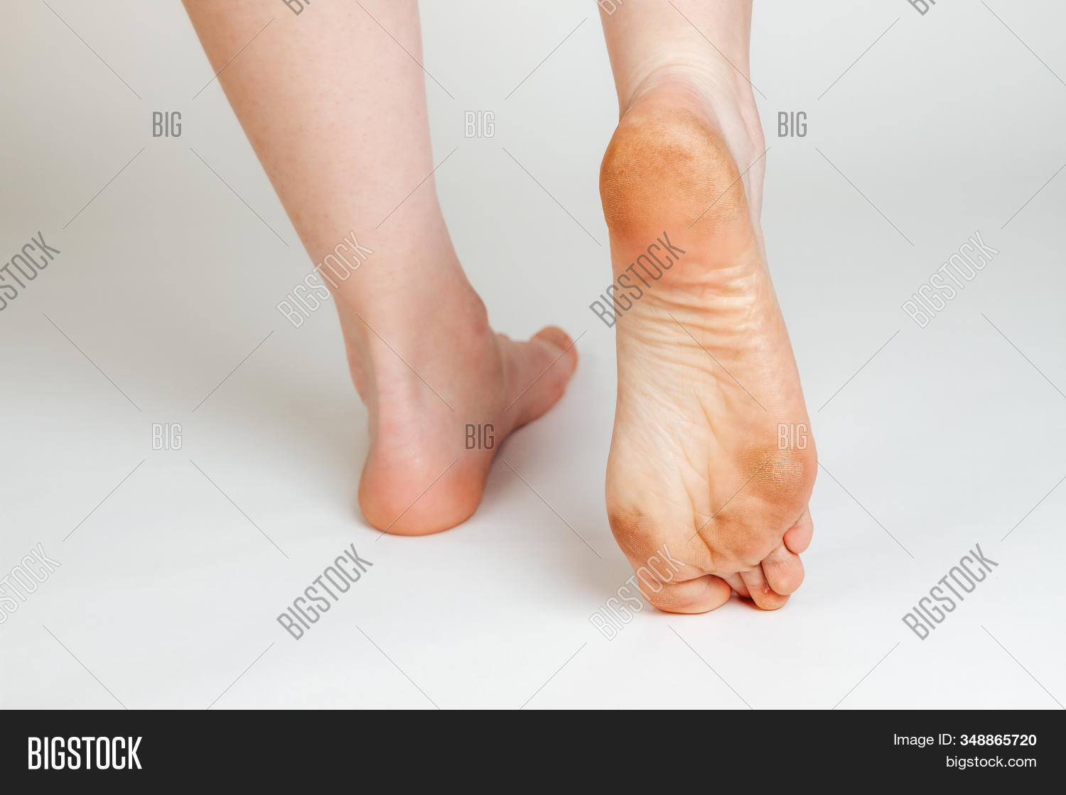 Female Feet Corns Image & Photo (Free Trial) Bigstock
