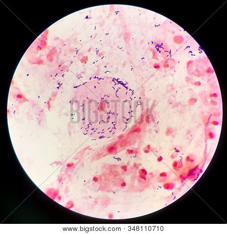 Gram Positive Bacilli On Red Background From Specimen Sputum.
