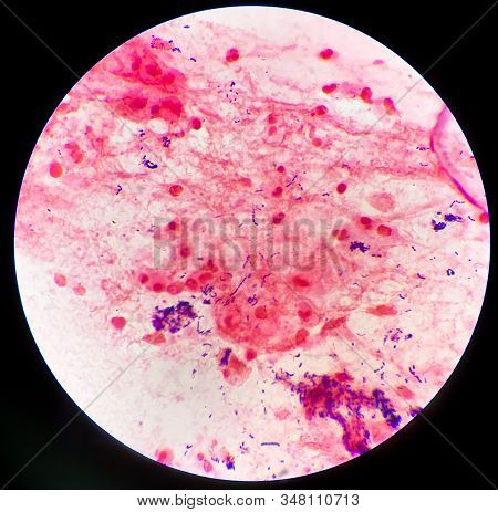 Gram Positive Bacilli On Red Background From Specimen Sputum.