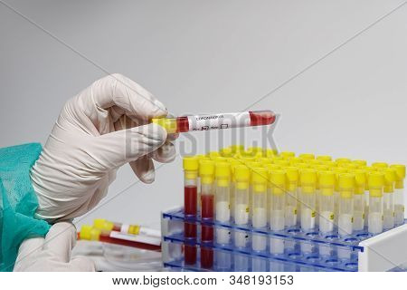 Coronavirus 2019-ncov World Outbreak Tests On Microbiology Lab. Chemist With Protective White Gloves