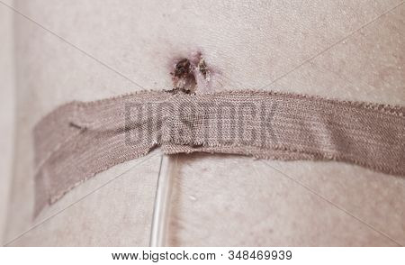 Lymphatic Drainage Duct In The Wound. Postoperative Removal Of Lymph To Avoid Edema. Lymphorrhea
