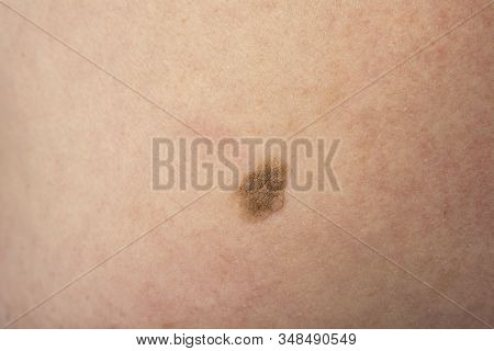 Human Skin Wart On A Woman Belly
