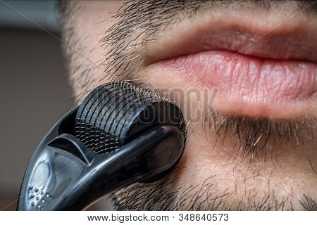 Facial Hair Care Concept. Young Man Is Using Derma Roller  On Beard.