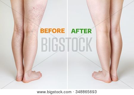 The Concept Of Varicose Veins And Cosmetic Treatment. Female Legs With With And Without Vascular Ast