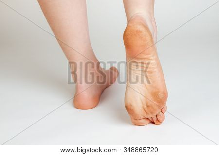 Female Feet With Corns And Calluses, On A White Background. Foot Close-up. Cosmetology And Medicine