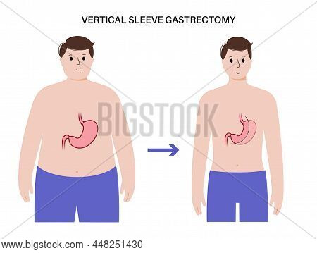 Vertical Sleeve Gastrectomy Anatomical Poster. Before And After Laparoscopy. Stomach Surgery, Weight