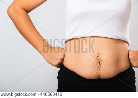 Close Up Of Asian Mother Woman Showing Stretch Mark Loose Lower Abdomen Skin She Fat After Pregnancy