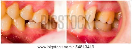 Composite Filling