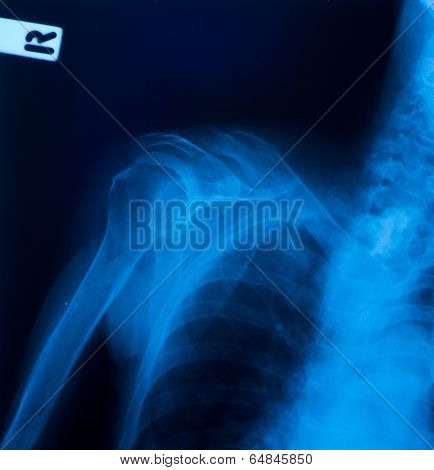 X ray film of clavicle fracture