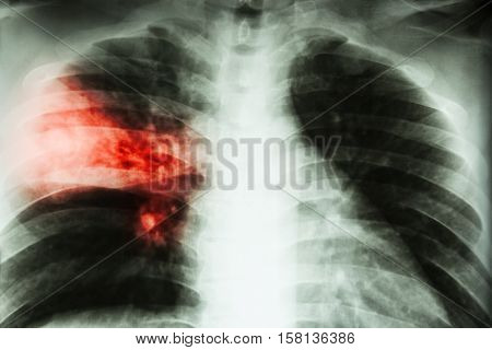 Lobar pneumonia . film chest x-ray show alveolar infiltration at right middle lobe due to tuberculosis infection .
