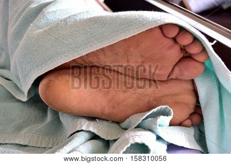 60 year foot Asian man with cracked soles.