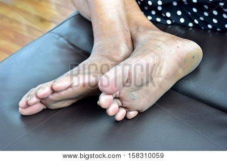 60 year foot Asian woman with cracked soles.