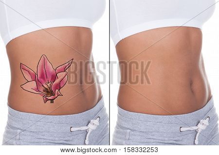 Close-up Of Woman Stomach Showing Before And After Laser Tattoo Removal Treatment