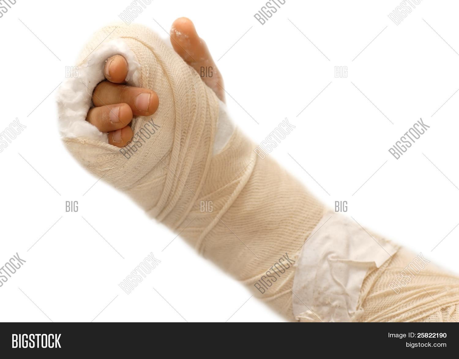 Broken Arm Image & Photo (Free Trial) | Bigstock