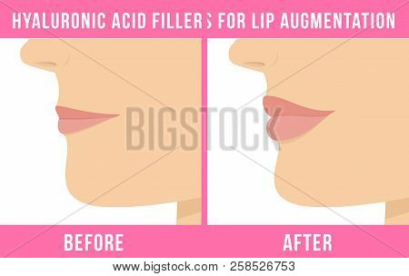 Woman Makes Procedure Of Beauty Injection For Lip Augmentation. Lips Before And After Hyaluronic Aci
