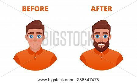 Sad Man With A Non-growing Beard. The Result Of The Use Of Minoxidil Or Hair Transplantation.