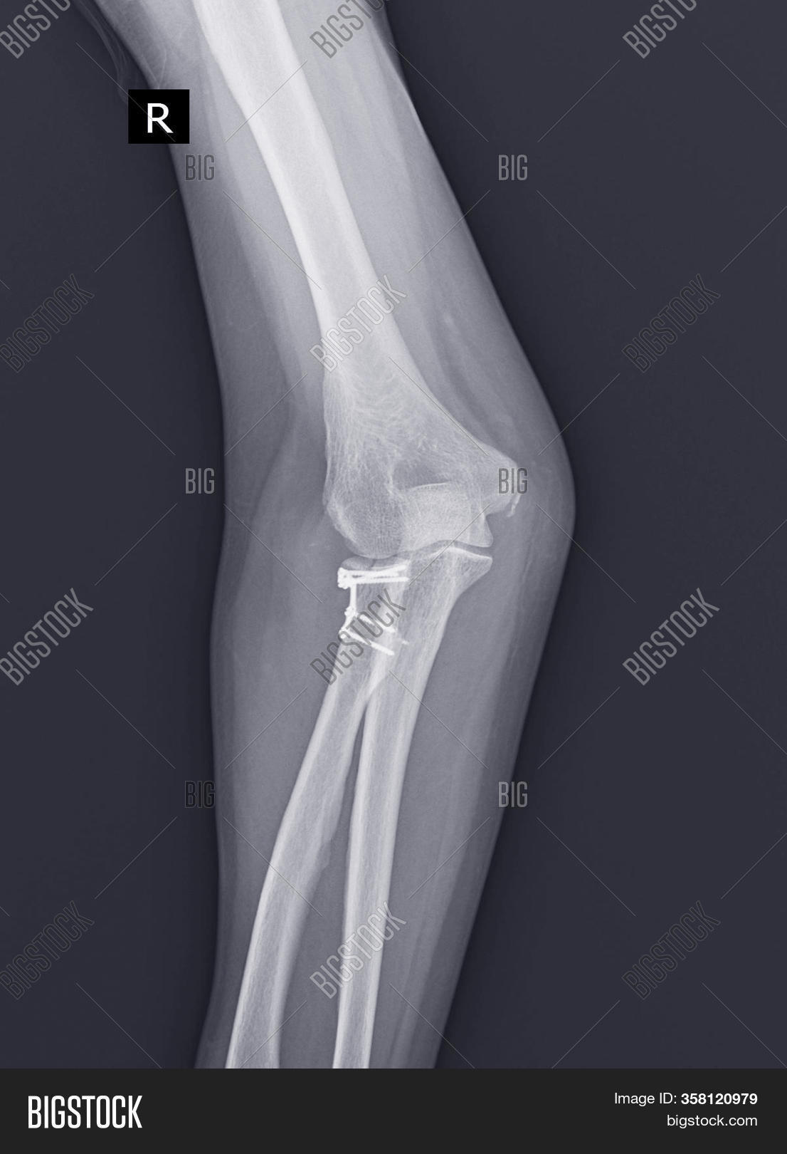 Xray Elbow Joint. Image & Photo (Free Trial) Bigstock