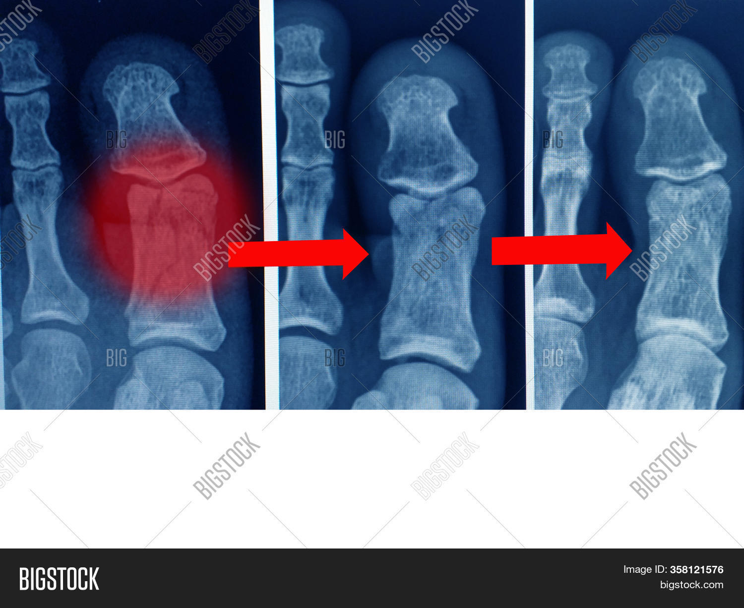 Xray Fracture Big Toe Image & Photo (Free Trial) Bigstock