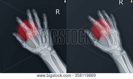 X-ray Right Hand (ap,oblique) Showing Closed Fracture Of Proximal Phalanx Of Right Index Finger Caus