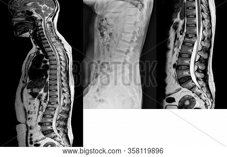 Lumbar Spine Lateral Views X-ray And Mri Scan Showing  Compression Fracture Of L2.medical Healthcare