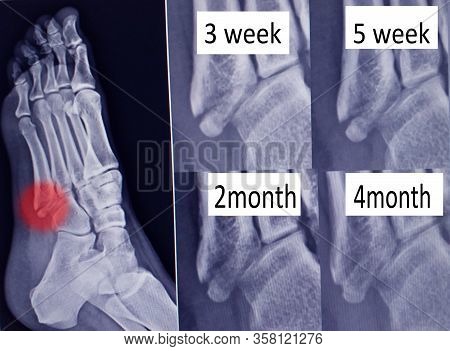 X -ray  Foot Bone Fracture ( Base Of Metatarsal Fracture ) From Traumatic Injury And Step View Union
