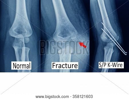 X-ray Elbow Showing  Supracondylar Humerus Fracture And Post Opretion Fix K-wire.medical Concept.