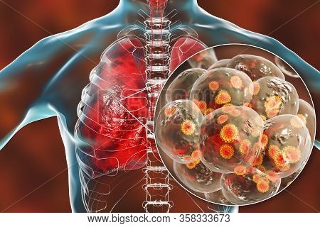Sars-cov-2 Viruses In Alveoli Of Human Lungs Causing Covid-19. Novel Coronavirus Infection, 3d Illus