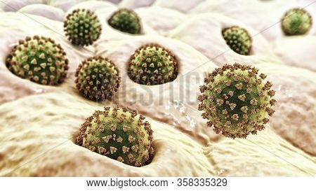 Coronaviruses Sars-cov-2 Infecting Human Alveoli Cells, The Concept Of Covid-19 Spread And Infection