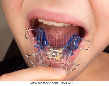 Funny Smile Teenager Wearing Orthodontic Braces And Showing Tongue. Teeth With Orthodontic Brackets.