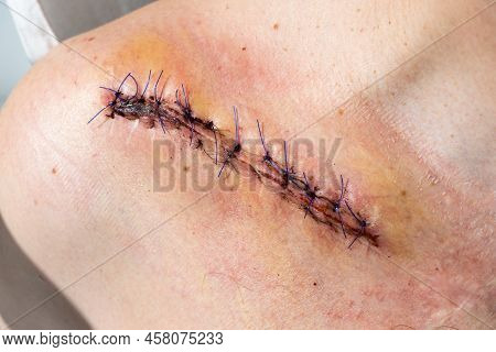 Suture Wound After Fracture Of The Right Clavicle After Surgery, Close Up Image