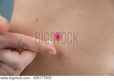 A Woman Smears Cream On A Wound After Burning A Wart.