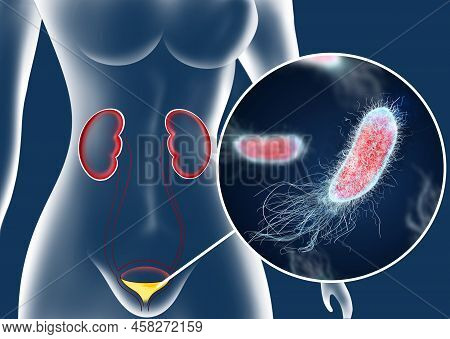 Illustration Of Woman Suffering From Cystitis. Urinary Infection