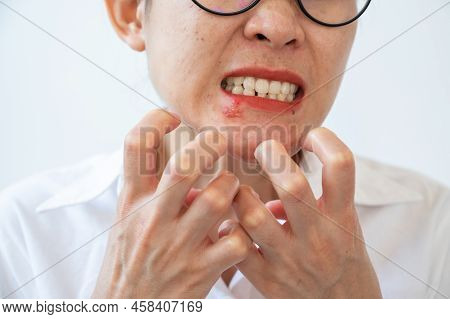 Woman Feeling Itch Cause Of Herpes Labialis On Her Lower Lip. Blisters That Break Open And Form Smal