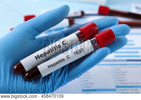 Scientist Holding Tubes With Blood Samples For Hepatitis Virus Test Near Laboratory Form, Closeup