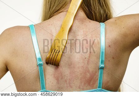 Itchy Skin, Dermatitis, Food Allergies. Woman Using Scratching Wood Stick To Scratch Her Back Side. 