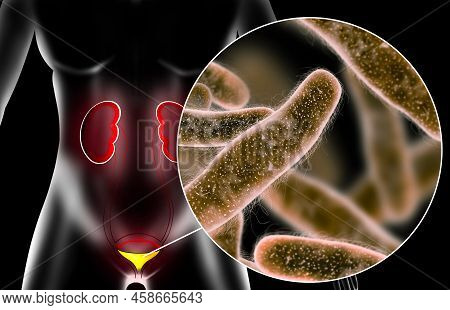 Illustration Of Woman Suffering From Cystitis. Urinary Infection