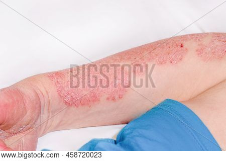 Acute Psoriasis On The Arm Of A Man, Severe Redness On The Skin, An Autoimmune Incurable Dermatologi